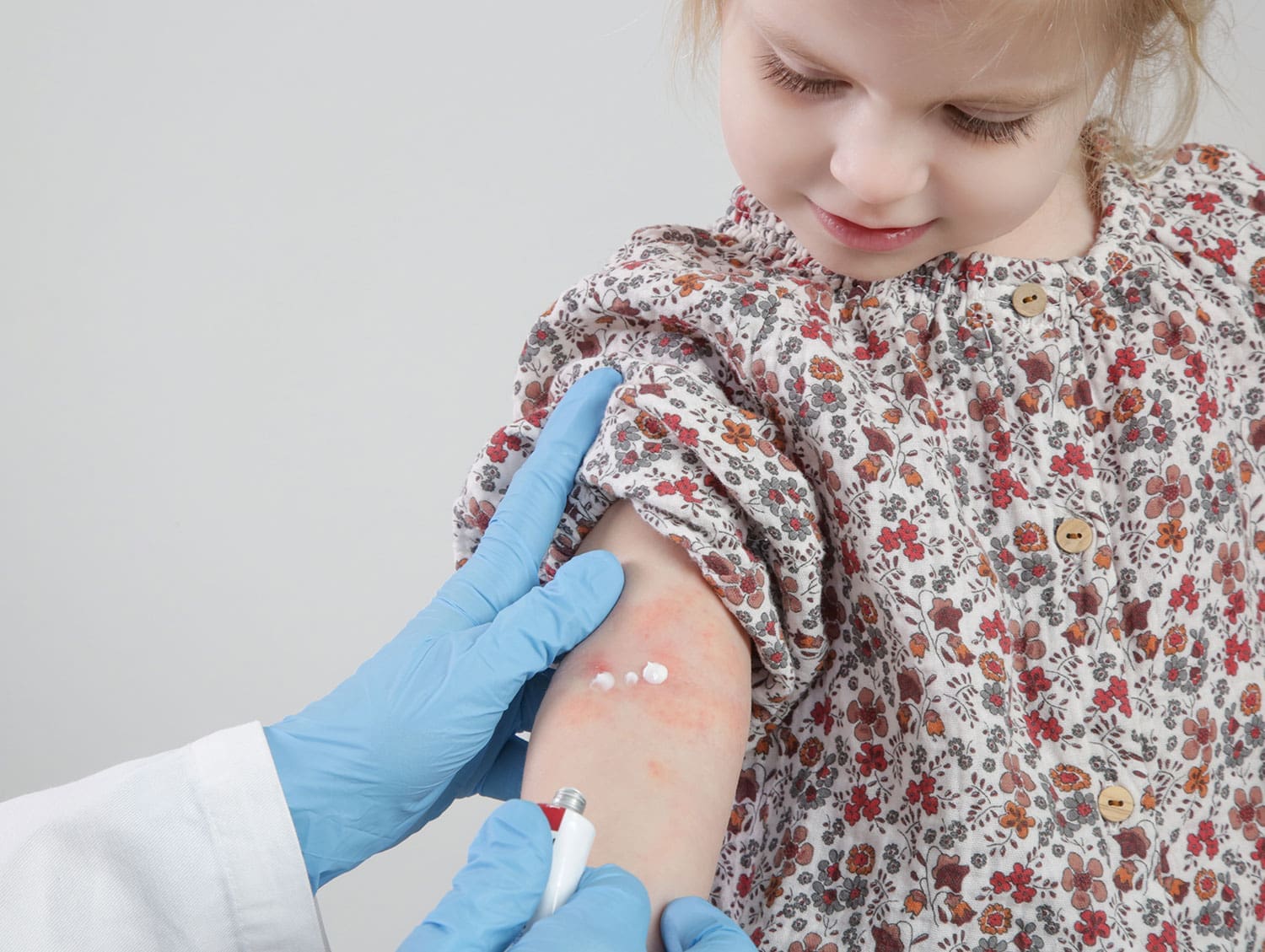 eczema1 A little girl is getting ointment rubbed into her eczema